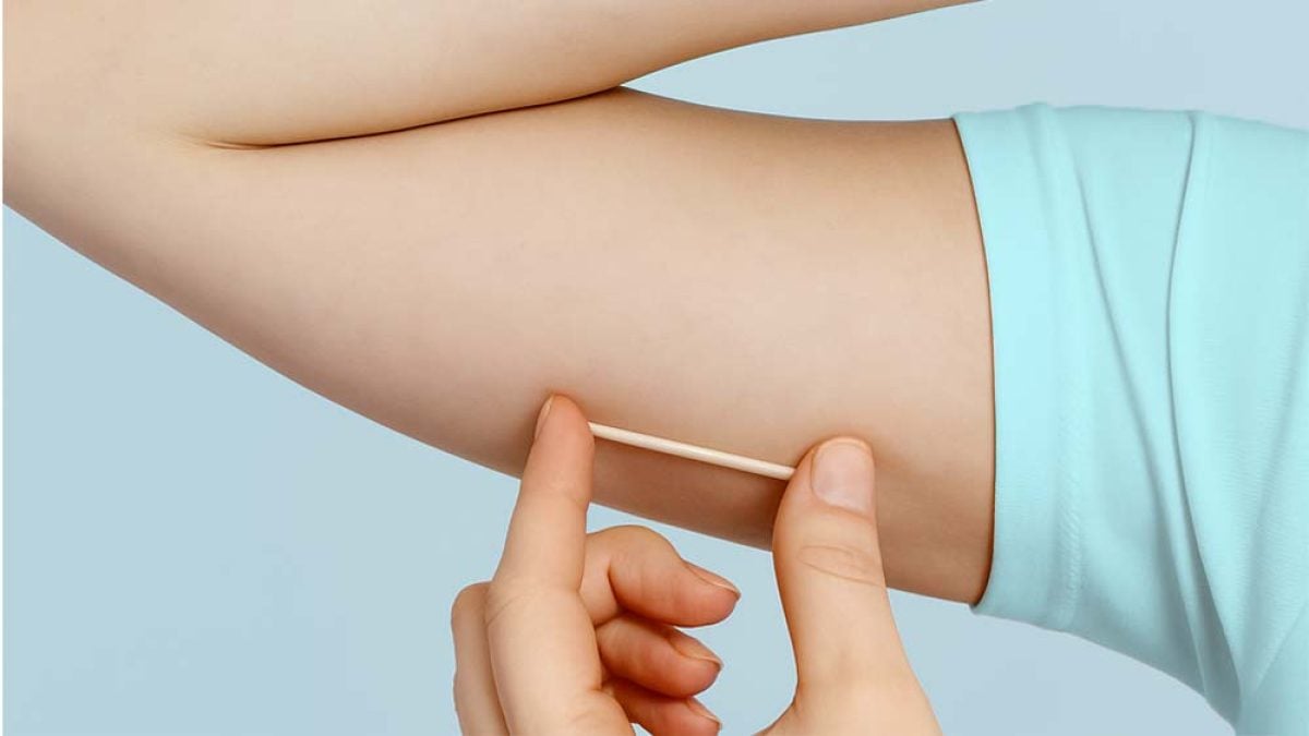 Campo Mourão disponibiliza novo método contraceptivo de longa duração nas UBS