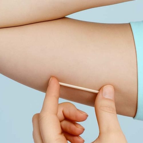 Campo Mourão disponibiliza novo método contraceptivo de longa duração nas UBS