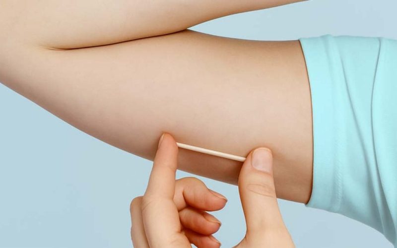 Campo Mourão disponibiliza novo método contraceptivo de longa duração nas UBS